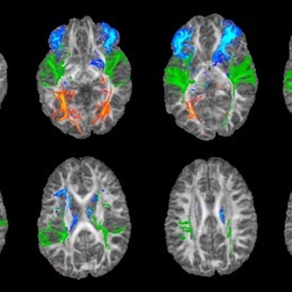 a series of brain images